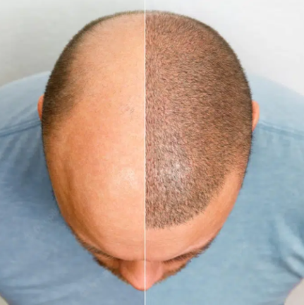 Insivo - Hair Transplant