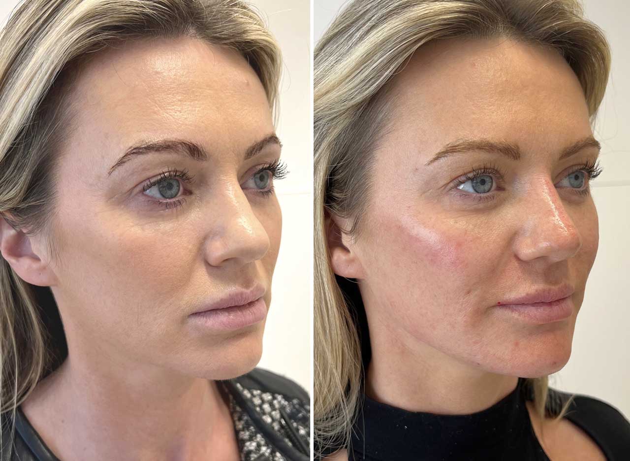 Insivo - Facial Rejuvenation