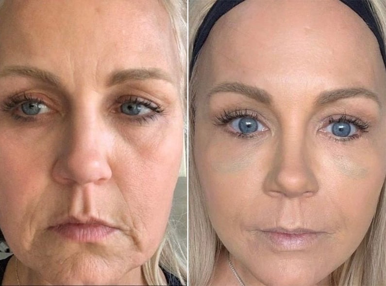 Insivo - Facial Rejuvenation