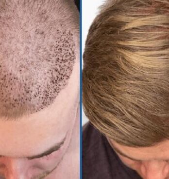 Insivo - Hair Transplant