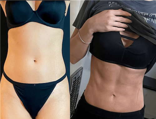 Insivo - Liposuction