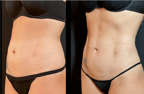 Insivo - Liposuction