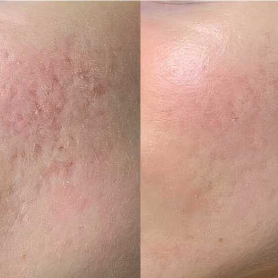 Insivo - Stem Cells